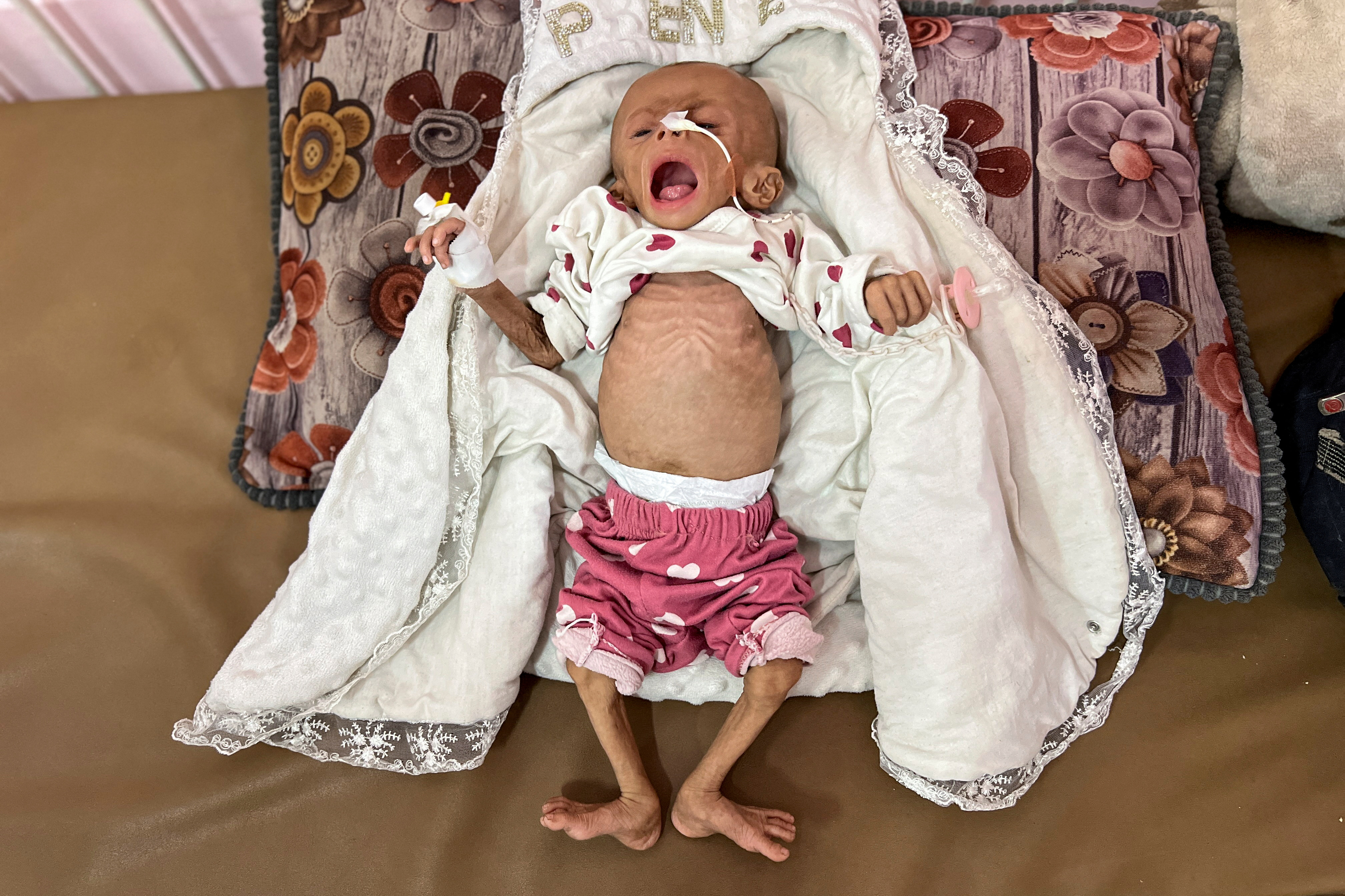 Zainab Abu Haleeb, a five-month-old Palestinian girl diagnosed with malnutrition, receives treatment at Nasser Hospital in Khan Younis, southern Gaza Strip
