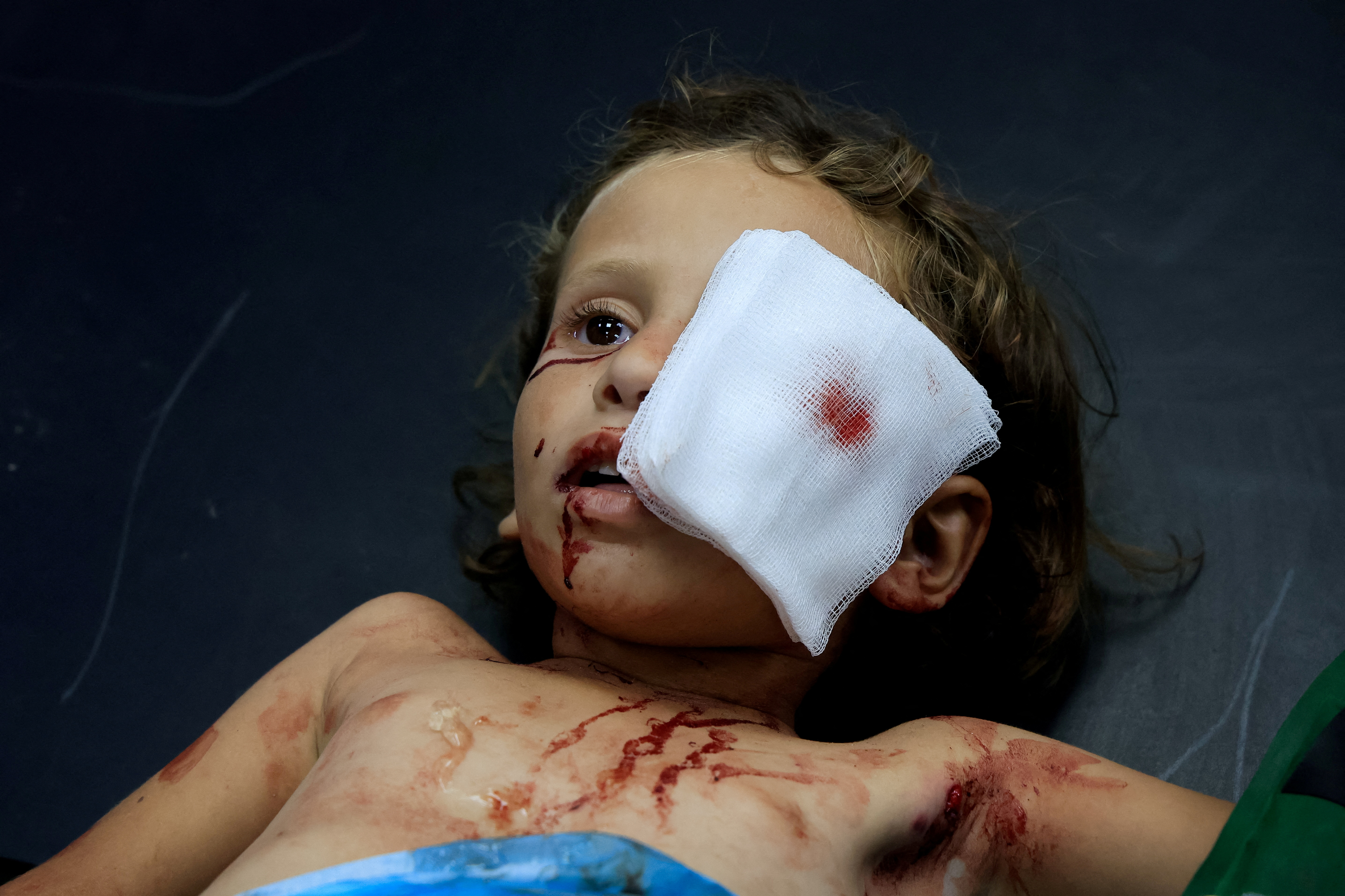SENSITIVE MATERIAL. THIS IMAGE MAY OFFEND OR DISTURB A wounded Palestinian girl receives treatment at Nasser Hospital after being injured in an Israeli strike, according to medics, in Khan Younis in the southern Gaza Strip, July 17, 2025. REUTERS/Hatem Khaled TPX IMAGES OF THE DAY